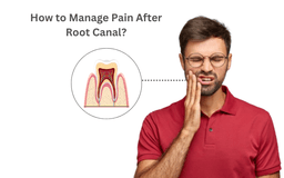 How to Manage Pain After Root Canal?